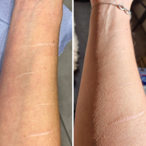 Pigmentation de cicatrices de scarifications après 1 séance