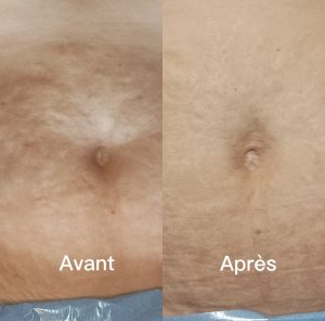 Vergetures Ventre